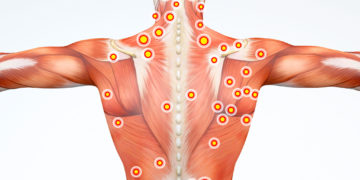 Points Trigger Myofasciaux . What’s the point ?