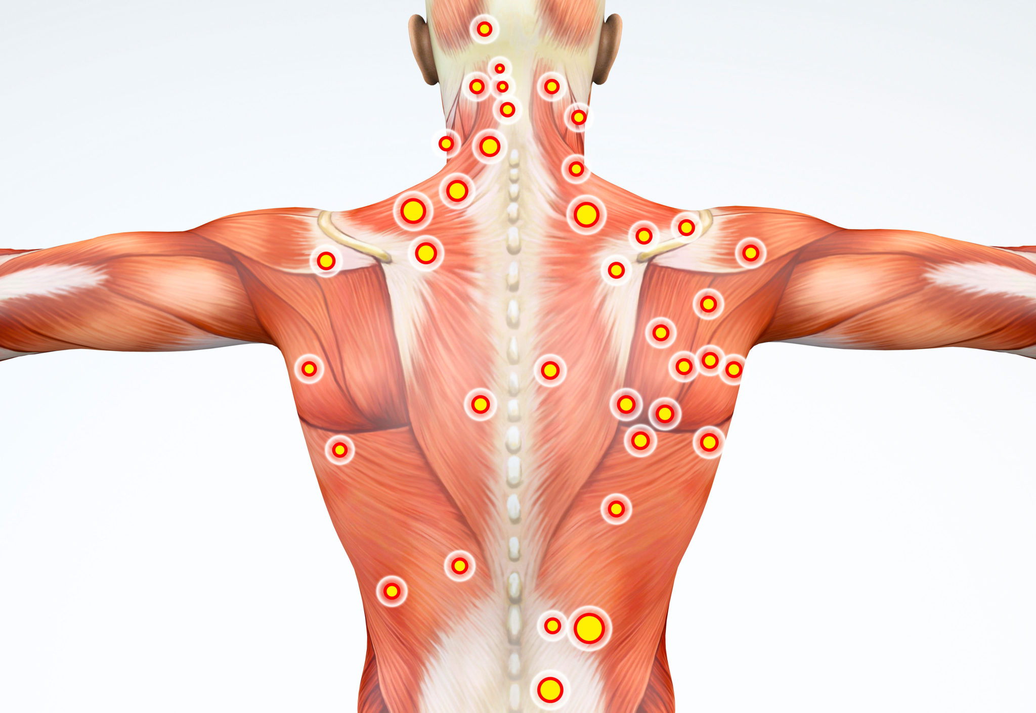 Points Trigger Myofasciaux What s The Point Centre Kin 